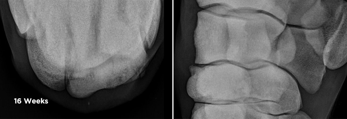 X_ray of Carpal fracture, 16 weeks post injury