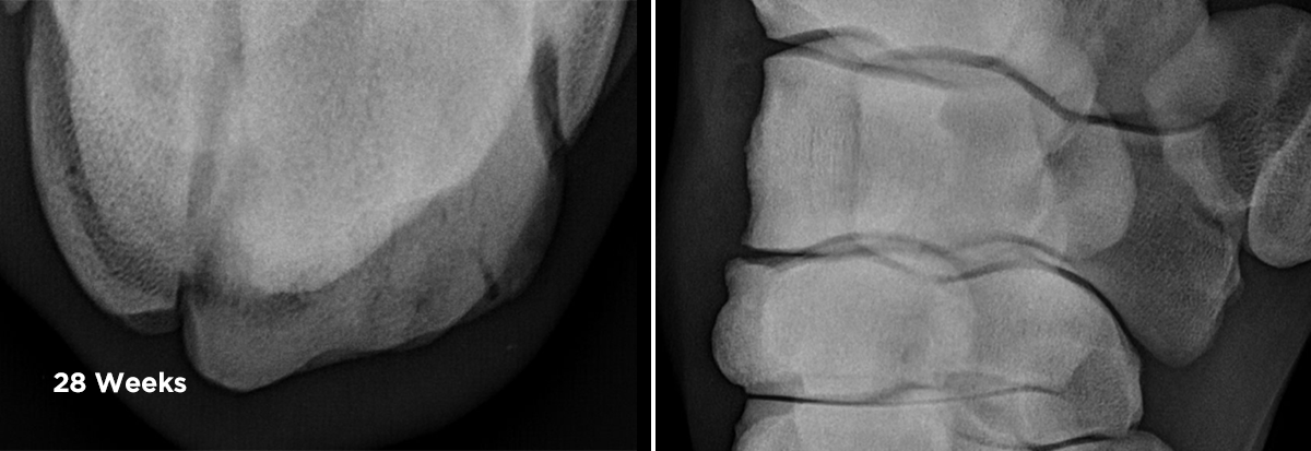 X_ray of Carpal fracture, 28 weeks post injury