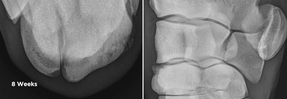 X_ray of Carpal fracture, 8 weeks post injury