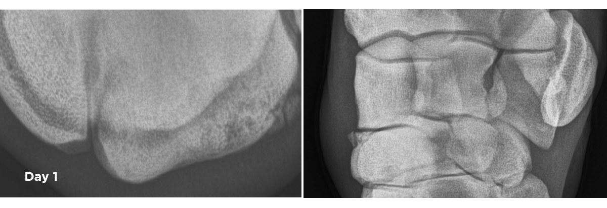 X_ray of Carpal fracture, 1 day post injury